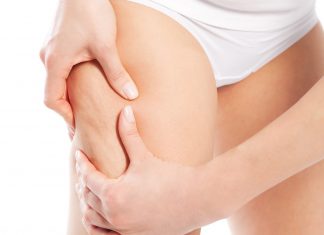 Ce este de fapt celulita si cum scapam de ea!