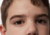 Molluscum contagiosum – o afectiune frecventa a copilariei