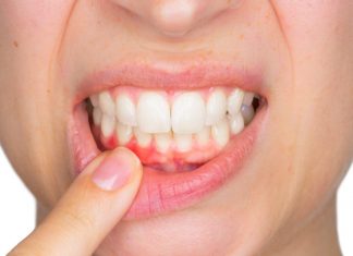 Cele mai bune alimente pentru a avea gingii sanatoase si pentru a le preveni sangerarea