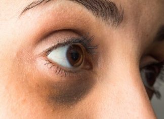 6 remedii naturale pentru ameliorarea cearcanelor