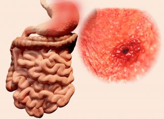 Ce este gastrita eroziva? Simptome, cauze si tratament